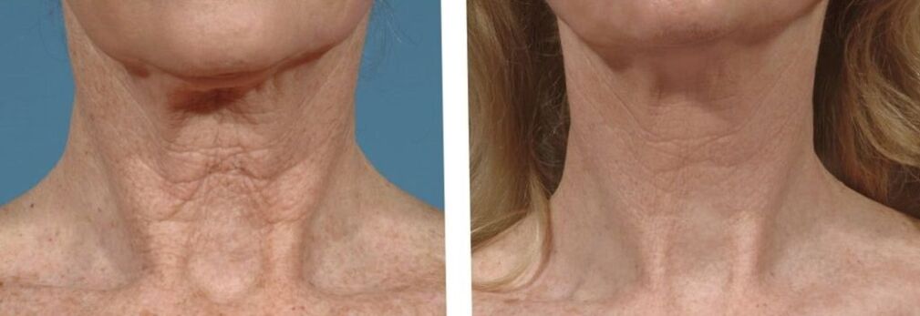 Neck skin before and after fractional rejuvenation