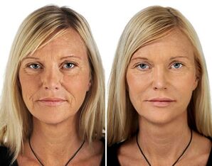 Comparison before and after