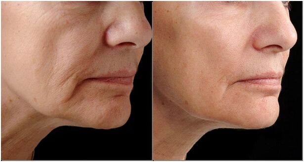 Before and after laser rejuvenation