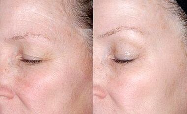 Rejuvenation of the skin around the eyes before and after photos