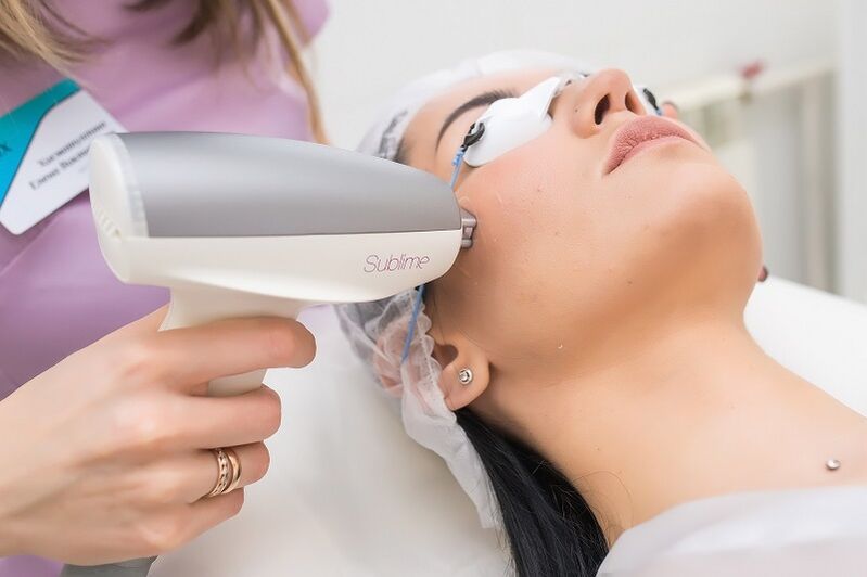 Performing laser skin rejuvenation