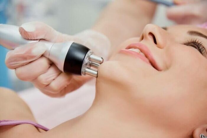 Radio wave lifting is an effective facial skin rejuvenation procedure