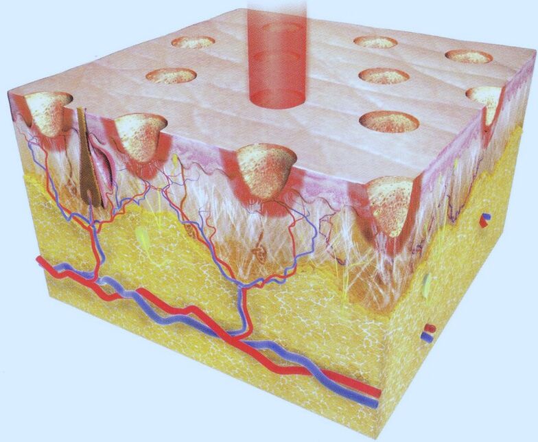 The laser burns out part of the skin cells, forcing their surroundings to increase regeneration. 